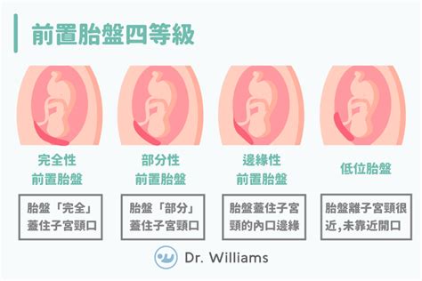 前置胎盤剝離|胎盤早剝(胎盤早期剝離):病因,臨床表現,檢查,診斷,鑑別診斷,治療,。